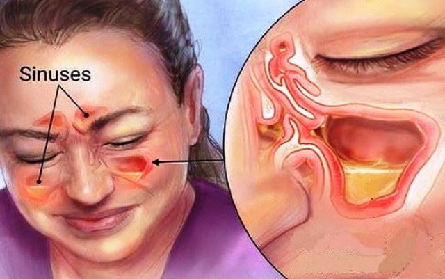 9 Gejala Dan Karakteristikkarakteristik Sinusitis Yang Perlu Diwaspadai