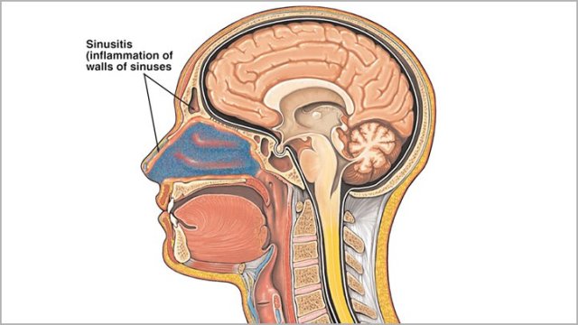 Does Sinus Infection Spread To Brain